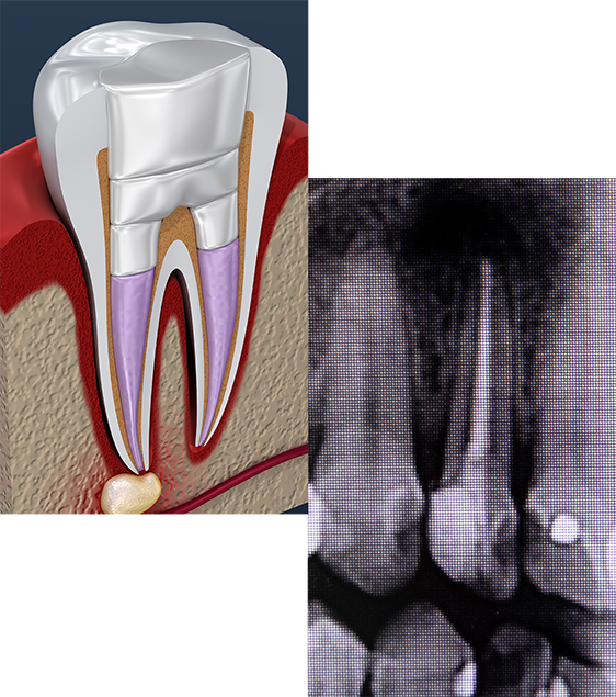 root canal